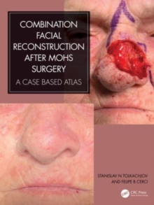 Combination Facial Reconstruction after Mohs Surgery: A Case Based Atlas