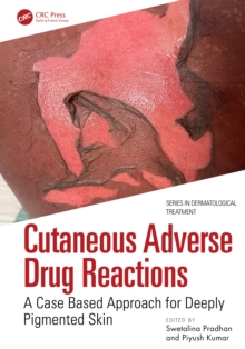 Image for Cutaneous Adverse Drug Reactions