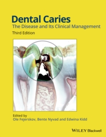 Image for Dental Caries : The Disease and its Clinical Management