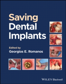 Long-Term Survival of Dental Implants