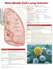 Image for Non-Small Cell Lung Cancer