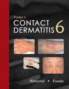 Image for Fisher's contact dermatitis
