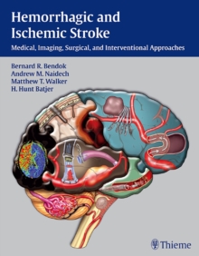 Image for Hemorrhagic and Ischemic Stroke