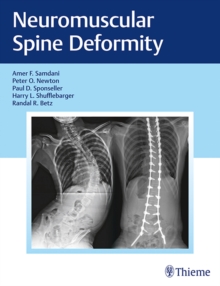 Image for Neuromuscular Spine Deformity