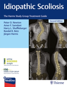 Image for Idiopathic scoliosis  : the Harms Study Group treatment guide