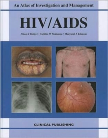 HIV/AIDS