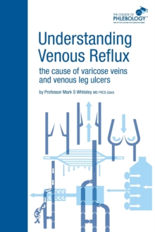 Image for Understanding venous reflux  : the cause of varicose veins and venous leg ulcers