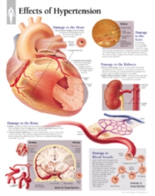 Image for Effects of Hypertension Laminated Poster