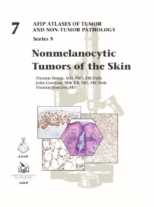 Image for Nonmelanocytic tumors of the skin