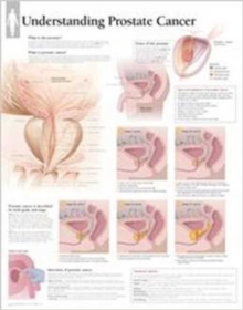 Understanding Prostate Cancer Laminated Poster