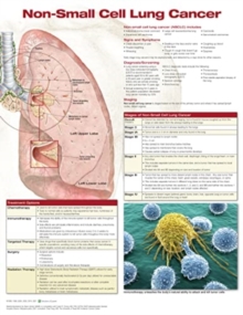 Image for Non-Small Cell Lung Cancer, Chart Laminated