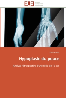 Image for Hypoplasie du pouce