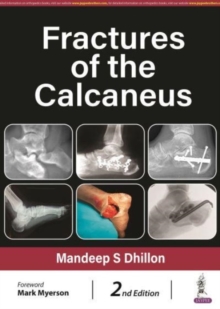 Image for Fractures of the Calcaneus